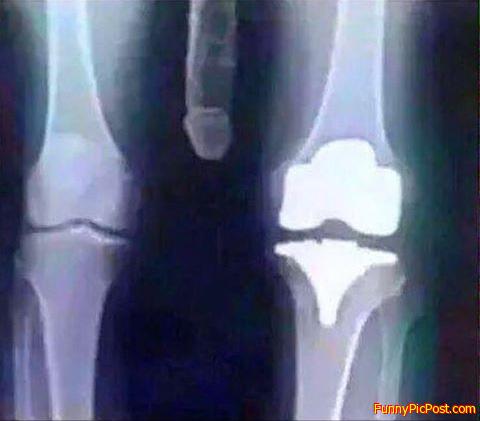 Knee X-ray